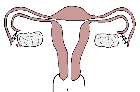Ectopic pregnancy